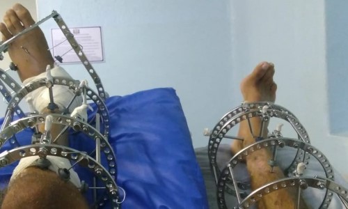 Paciente da saúde pública de Resende é recuperado com trabalho em equipe